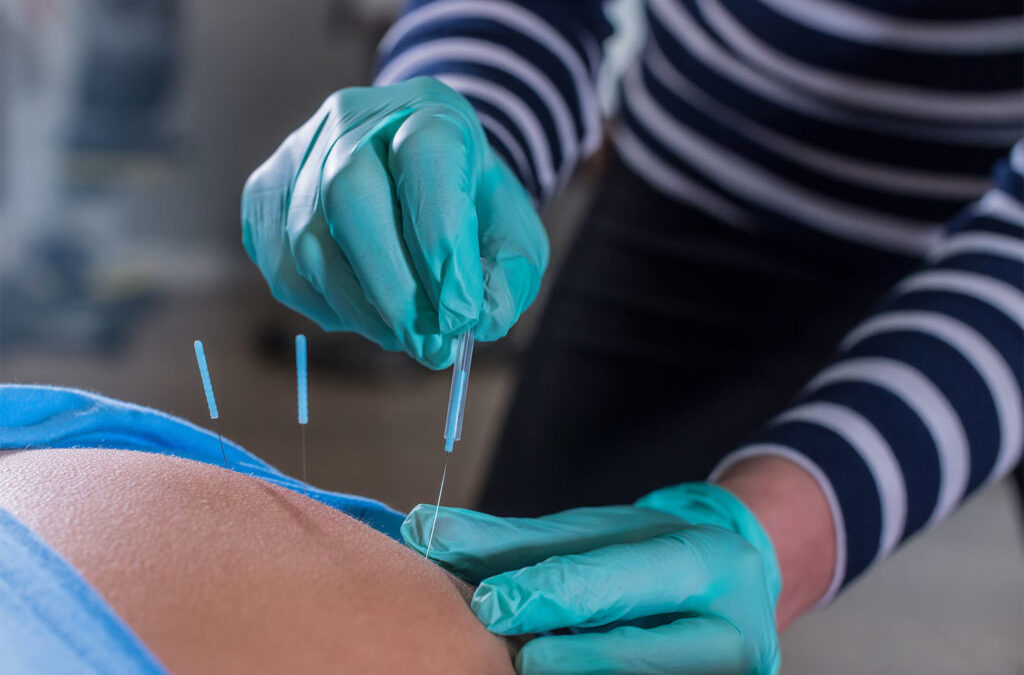 Is Dry Needling the Right Pain Treatment for Me?